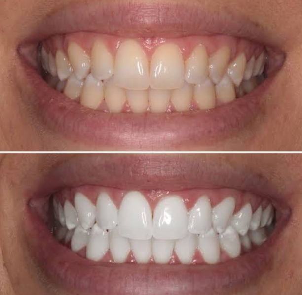 Teeth Whitening Vadodara